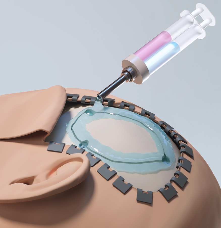 聚乙二醇化水凝膠